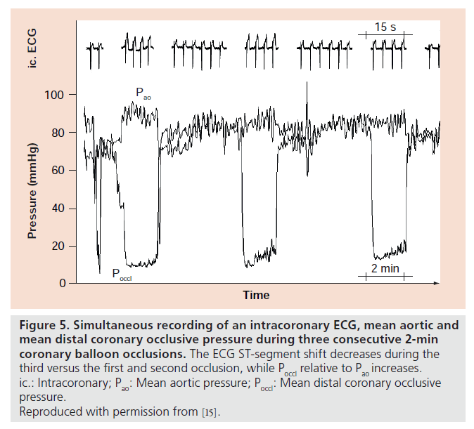 interventional-cardiology-balloon-occlusions