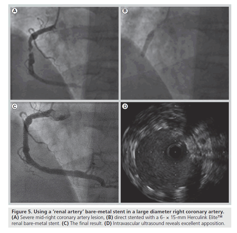 interventional-cardiology-bare-metal