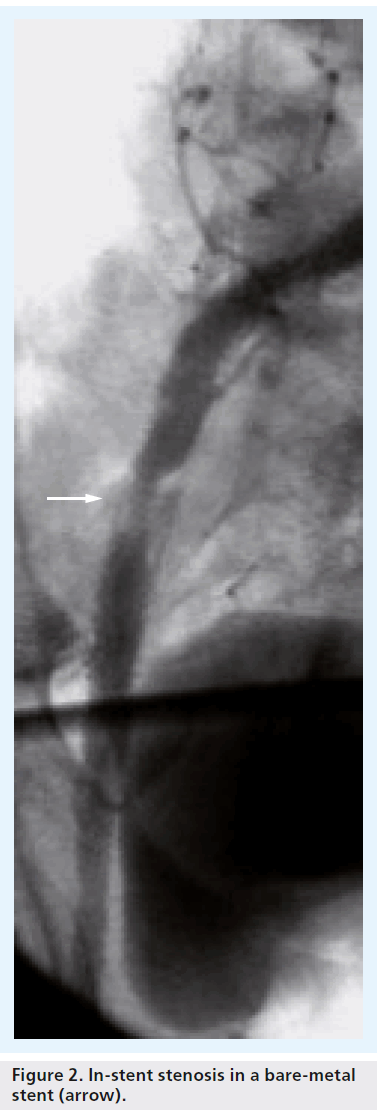 interventional-cardiology-bare-metal