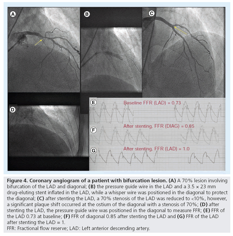 interventional-cardiology-bifurcation-lesion