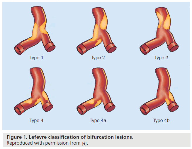 interventional-cardiology-bifurcation-lesions