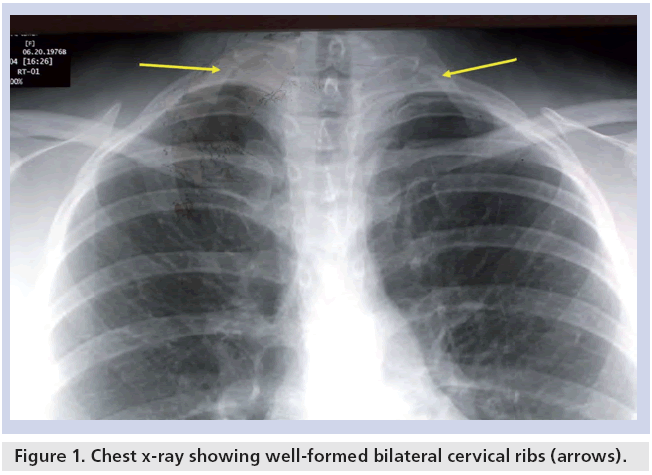 interventional-cardiology-bilateral-cervical-ribs