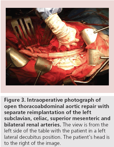 interventional-cardiology-bilateral-renal-arteries