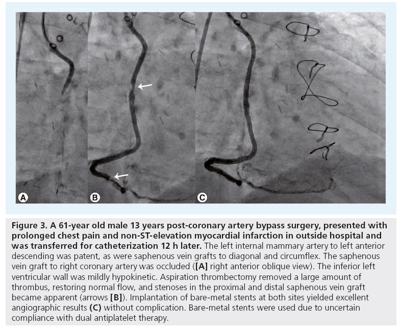 interventional-cardiology-bypass-surgery