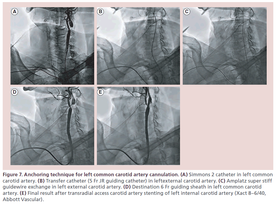 interventional-cardiology-carotid-artery