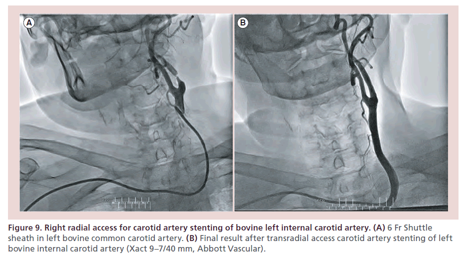 interventional-cardiology-carotid-artery