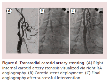 interventional-cardiology-carotid-artery-stenting