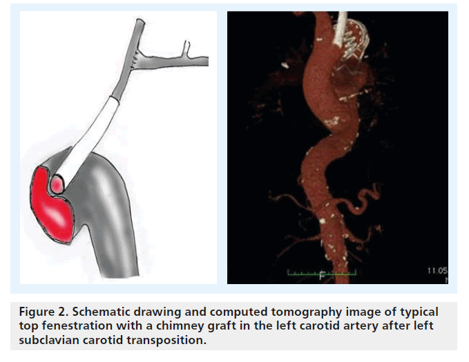 interventional-cardiology-carotid-transposition