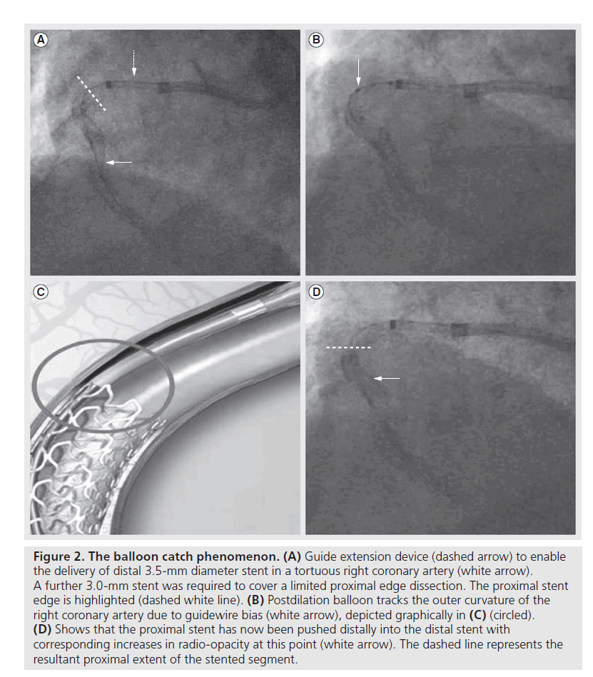 interventional-cardiology-catch-phenomenon