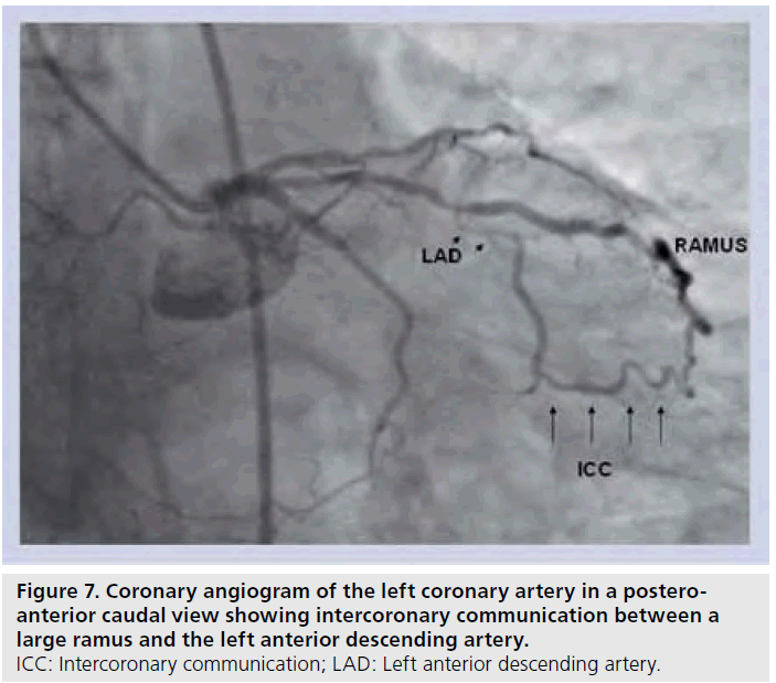 interventional-cardiology-caudal