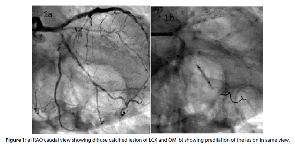 interventional-cardiology-caudal-lesion