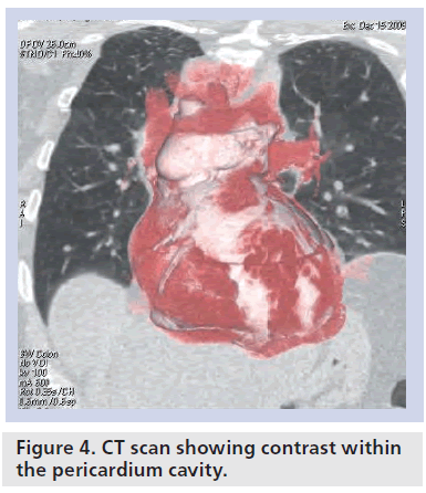 interventional-cardiology-cavity