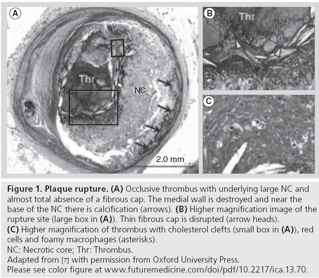 interventional-cardiology-cells-foamy-macrophages