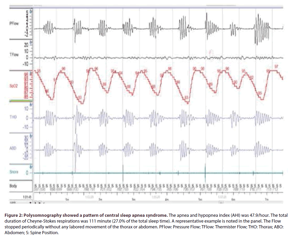 interventional-cardiology-central-sleep-apnea-syndrome