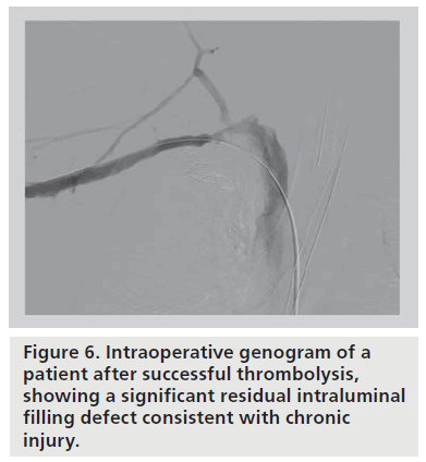 interventional-cardiology-chronic-injury