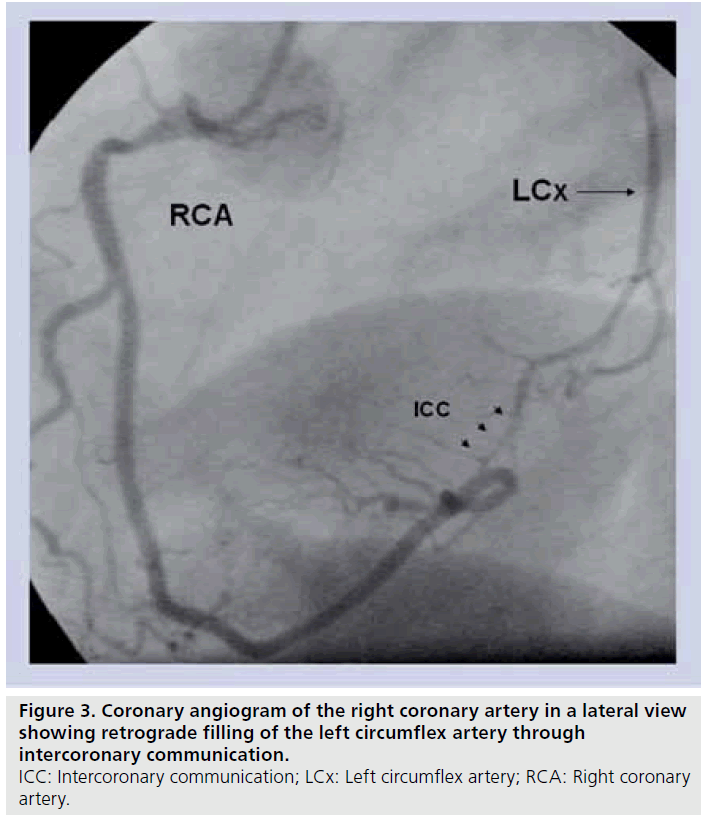 interventional-cardiology-circumflex