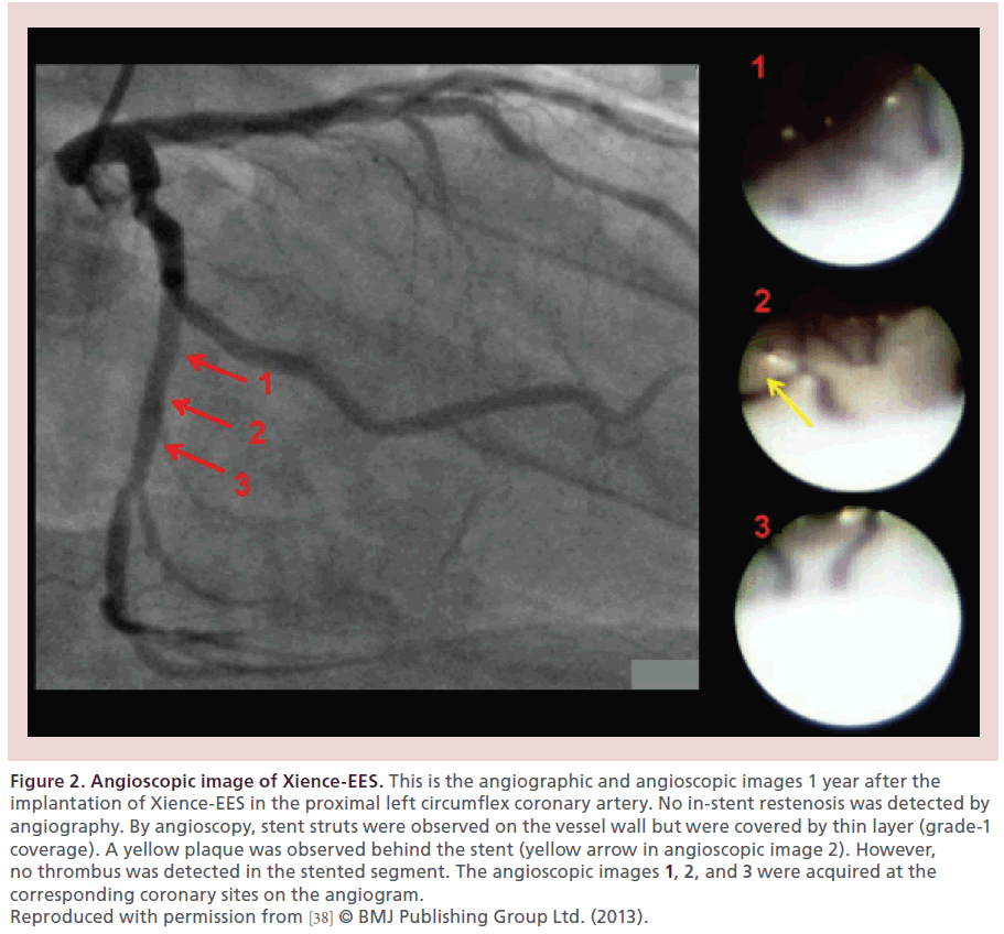 interventional-cardiology-circumflex