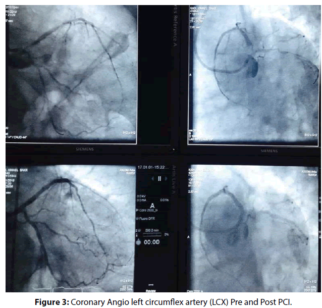 interventional-cardiology-circumflex-artery