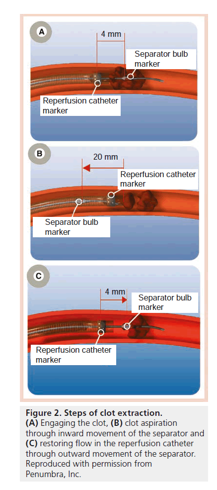 interventional-cardiology-clot-extraction