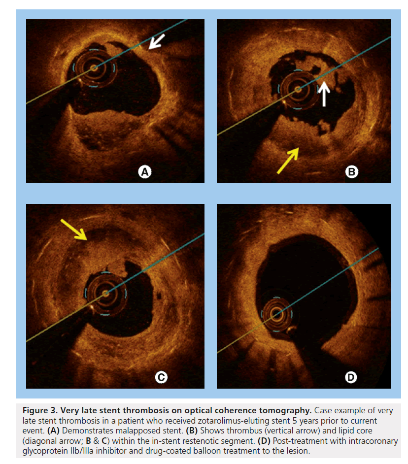 interventional-cardiology-coherence-tomography