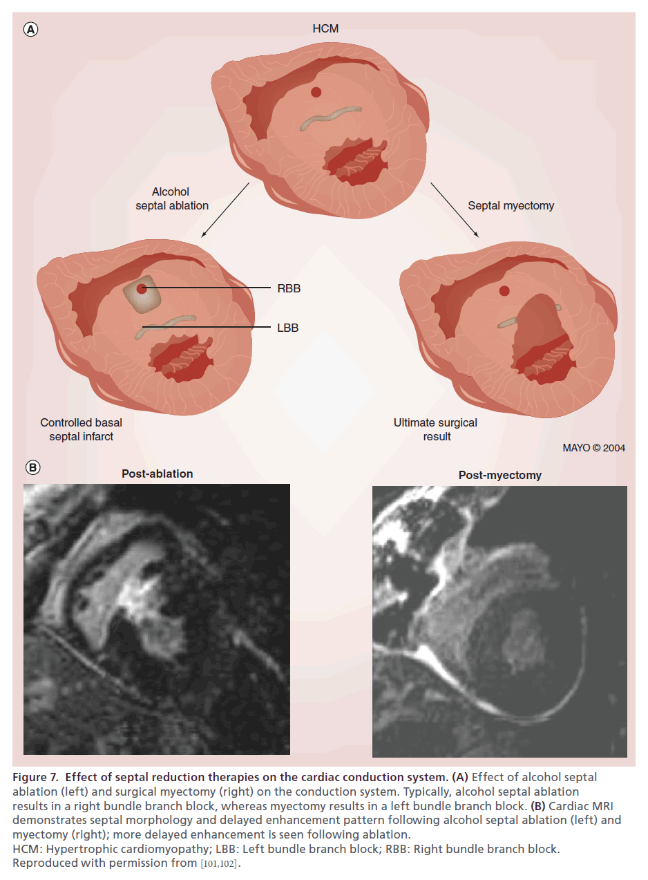 interventional-cardiology-conduction-system