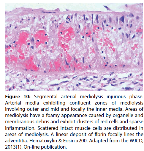 interventional-cardiology-confluent-zones