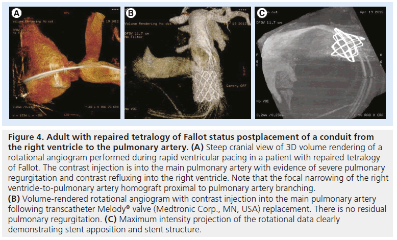 interventional-cardiology-contrast-injection
