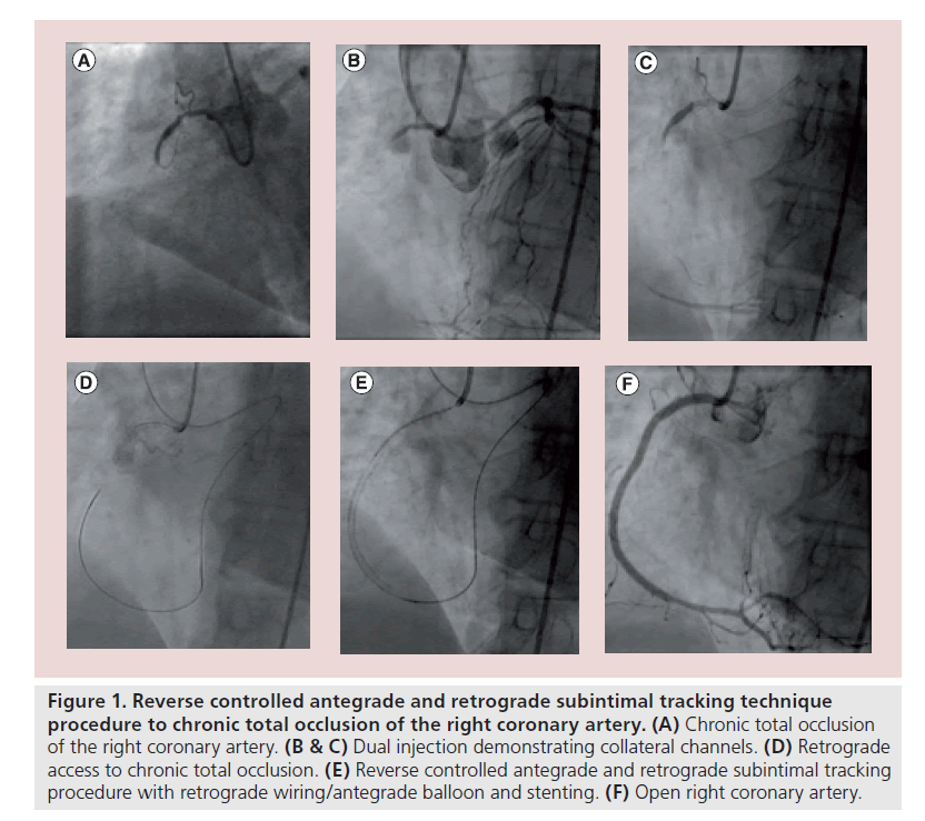 interventional-cardiology-controlled-antegrade