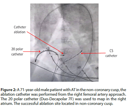 interventional-cardiology-coronary