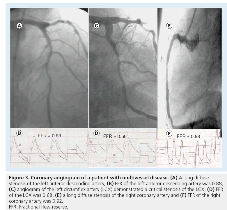 interventional-cardiology-coronary-angiogram