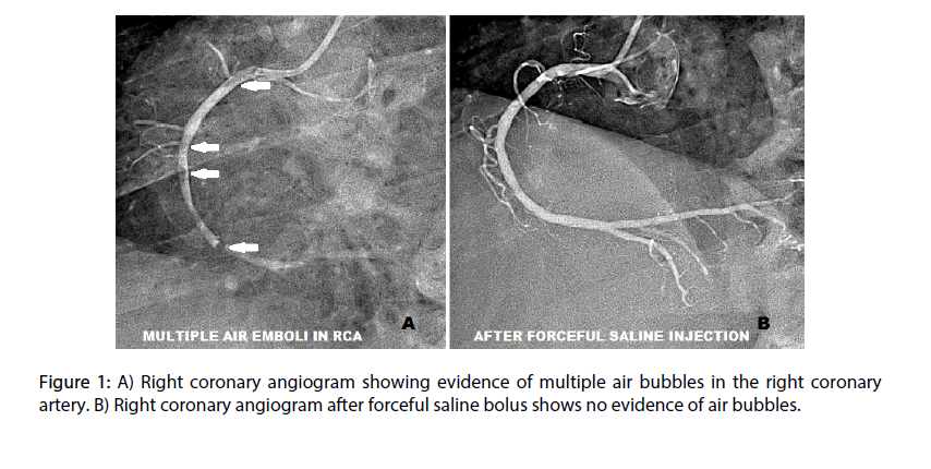 interventional-cardiology-coronary-angiogram