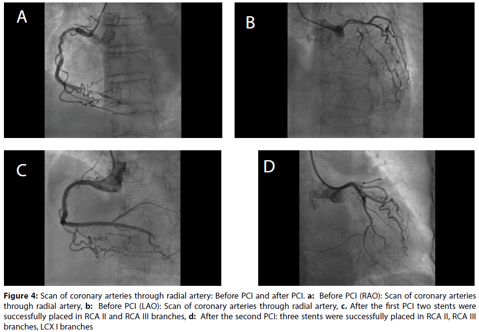 interventional-cardiology-coronary-arteries