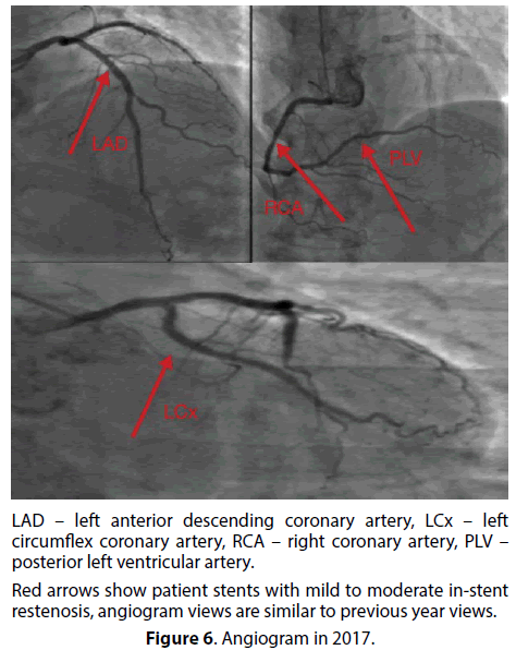 interventional-cardiology-coronary-artery