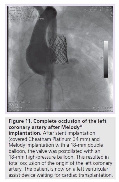 interventional-cardiology-coronary-artery