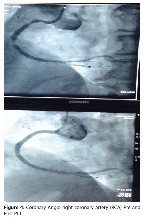 interventional-cardiology-coronary-artery