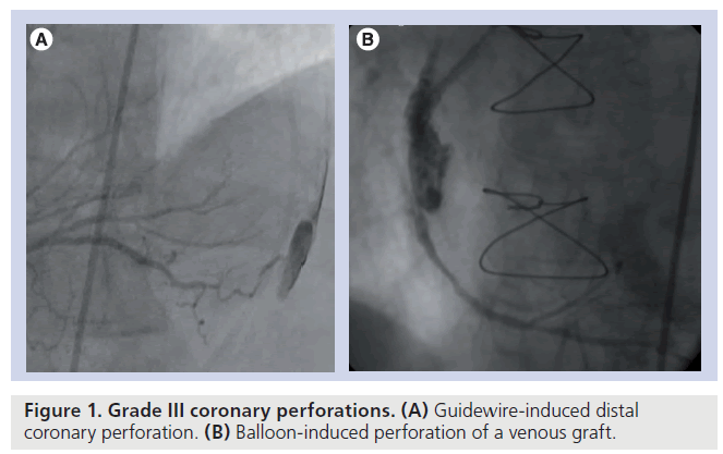 interventional-cardiology-coronary-perforations