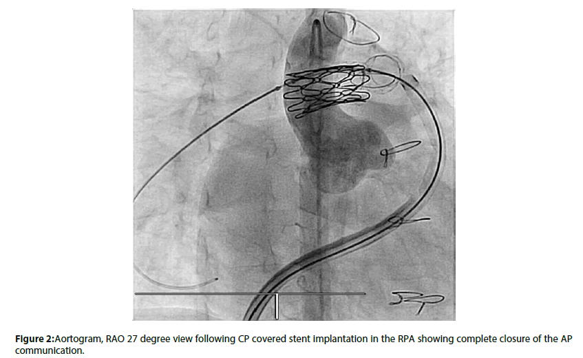 interventional-cardiology-covered-stent