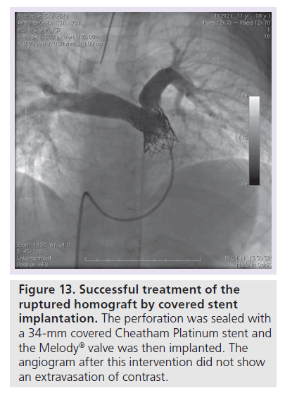 interventional-cardiology-covered-stent