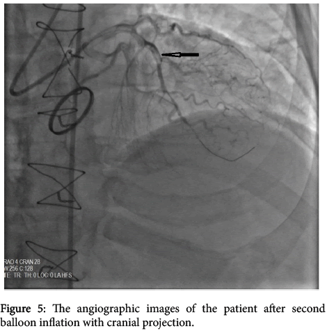 interventional-cardiology-cranial-projection