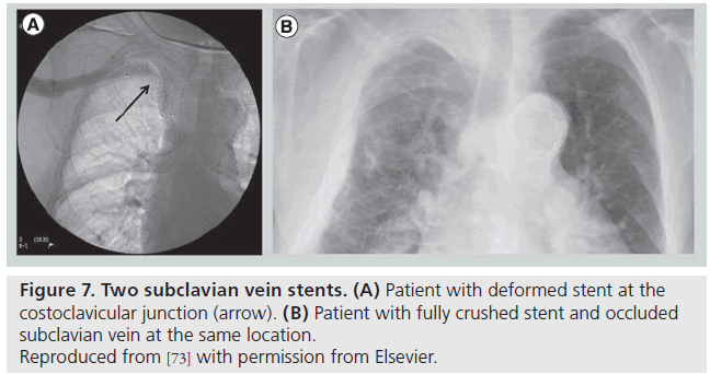 interventional-cardiology-crushed-stents