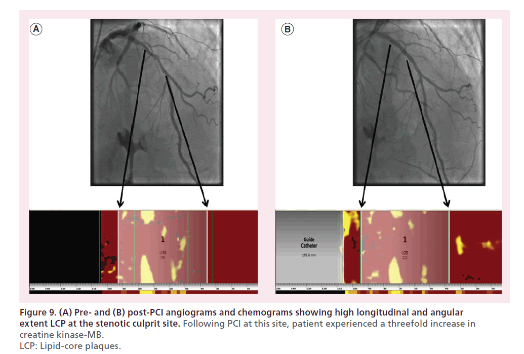 interventional-cardiology-culprit-site