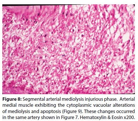 interventional-cardiology-cytoplasmic-vacuolar