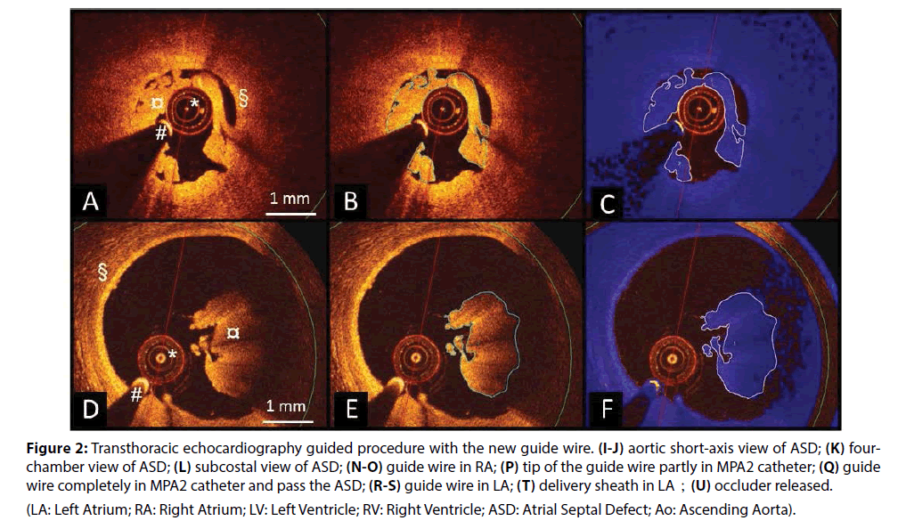 interventional-cardiology-delivery-sheath
