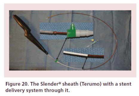 interventional-cardiology-delivery-system