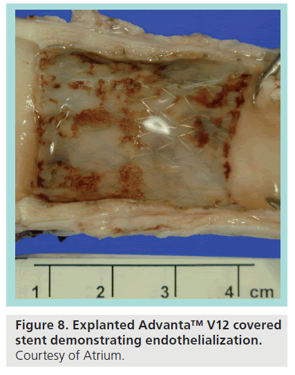 interventional-cardiology-demonstrating-endothelialization