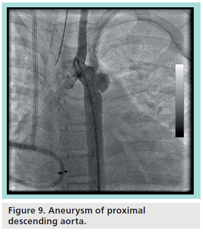 interventional-cardiology-descending-aorta