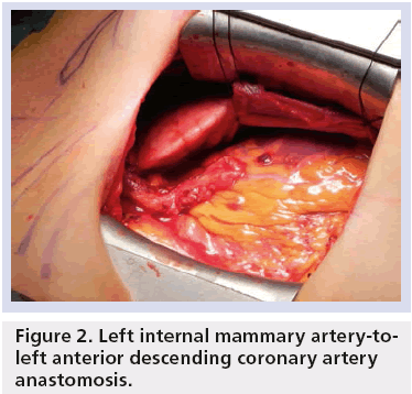 interventional-cardiology-descending-coronary-artery