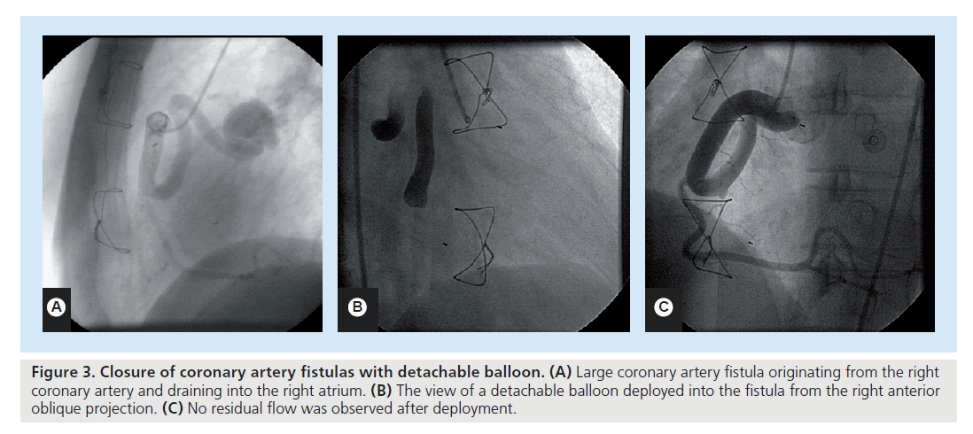 interventional-cardiology-detachable-balloon