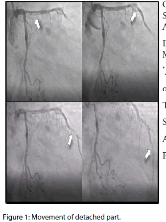 interventional-cardiology-detached-part