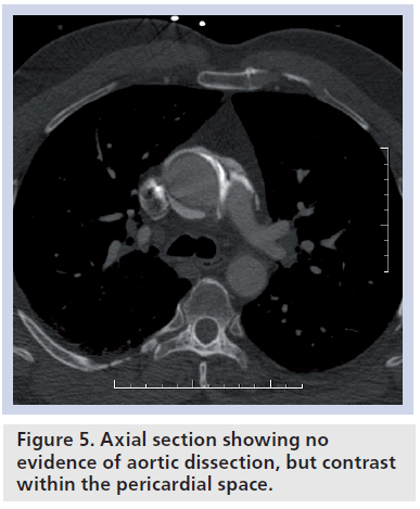 interventional-cardiology-dissection